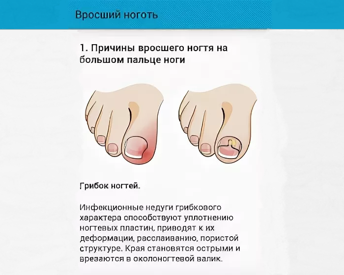Травма ногтя (повреждение ногтевой пластины) — подологическая обработка в студии подологии valgo podocare